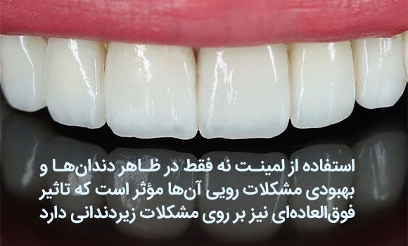 بهترین روش بستن فاصله بین دندان ها را در اینجا بخوانید
