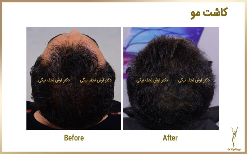 علل ریزش مو در تابستان و روش های جلوگیری از آن