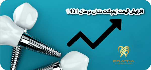 افزایش قیمت ایمپلنت دندان در سال 1401